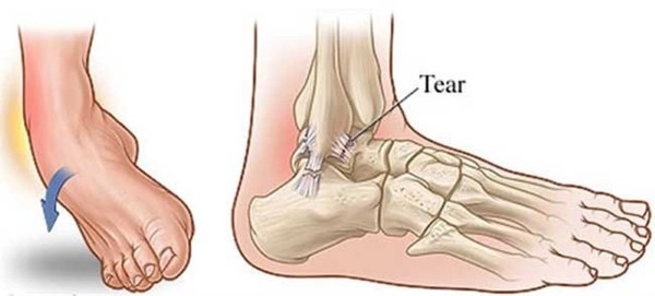 Dấu hiệu nhận biết khi bị lật cổ chân